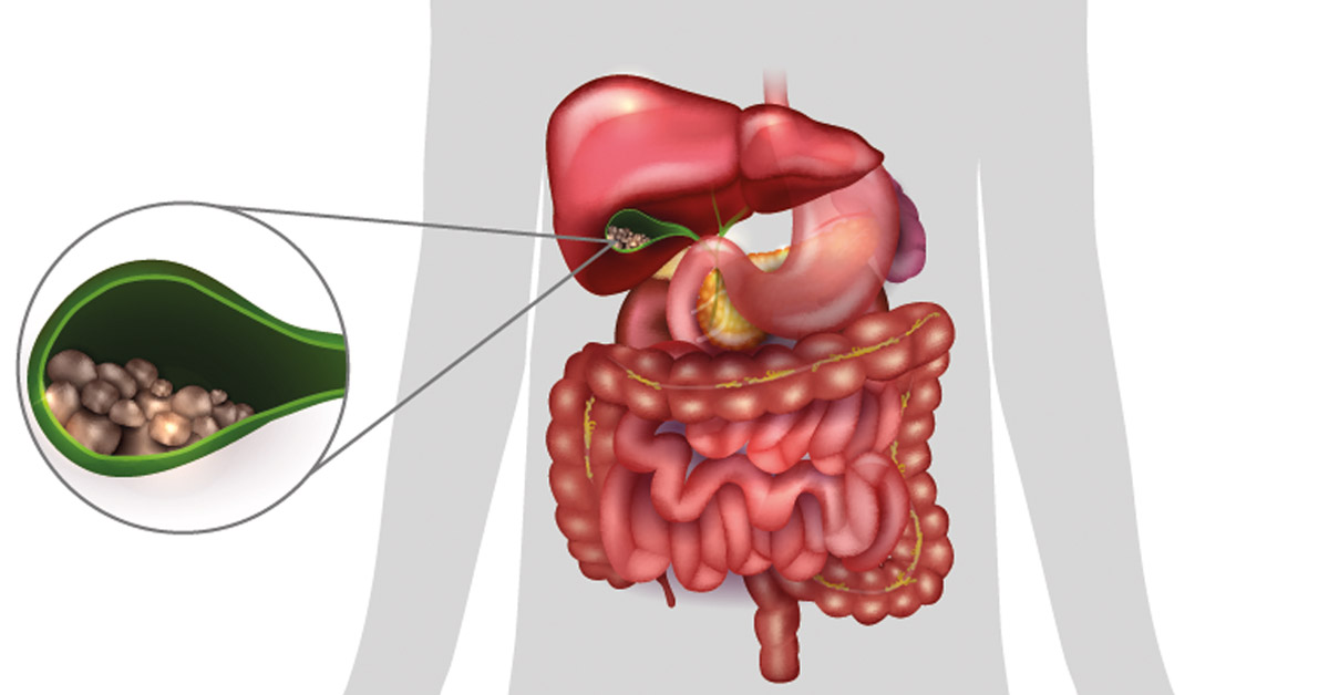 Safra Taşlarının Nedenleri ve Belirtileri