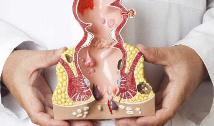 Dış Basur Memesi Kendiliğinden Geçer Mi?