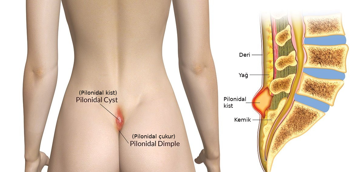Kıl Dönmesi (Pilonidal Sinüs) ve Tedavi Seçenekleri