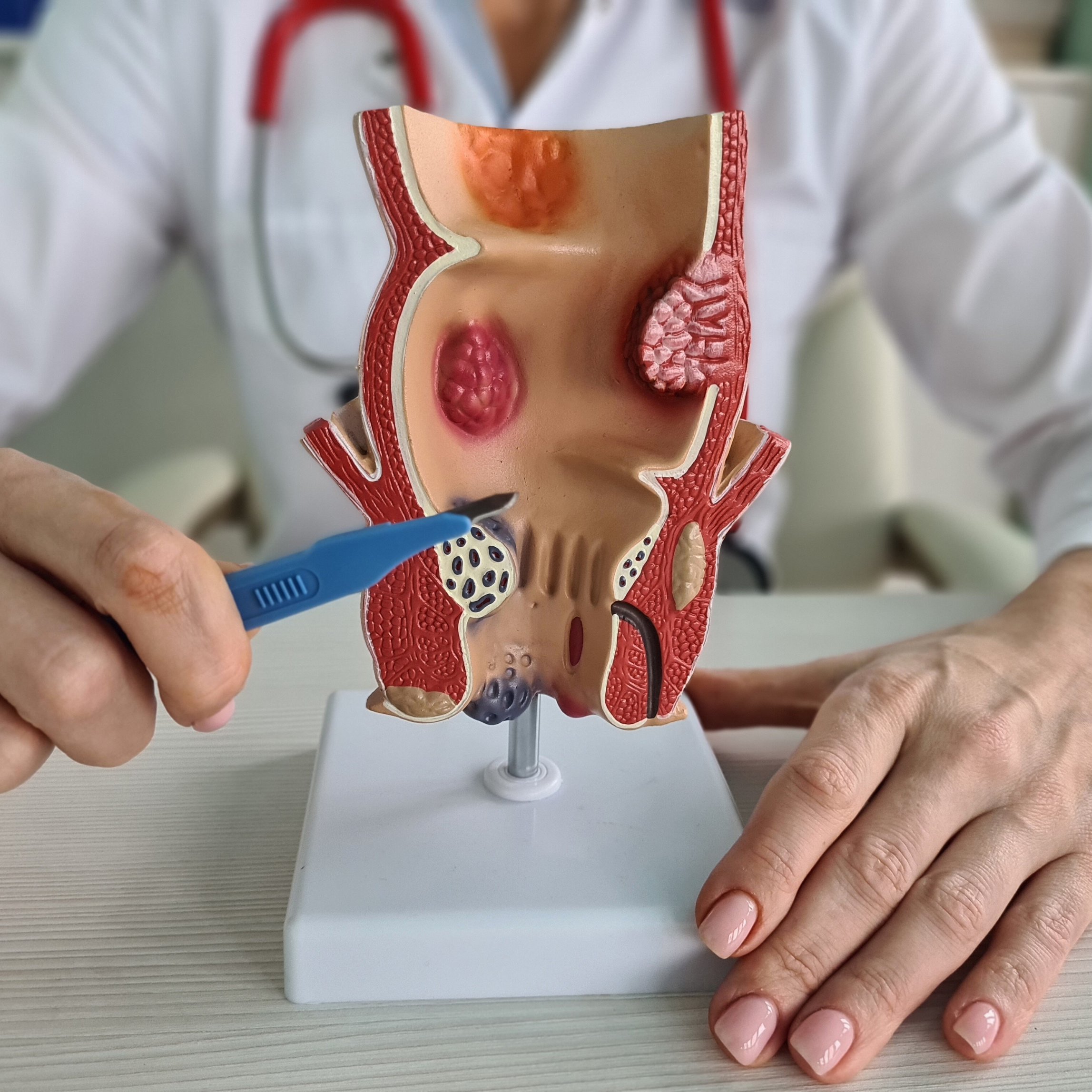 Hemoroid Tipleri Nelerdir?