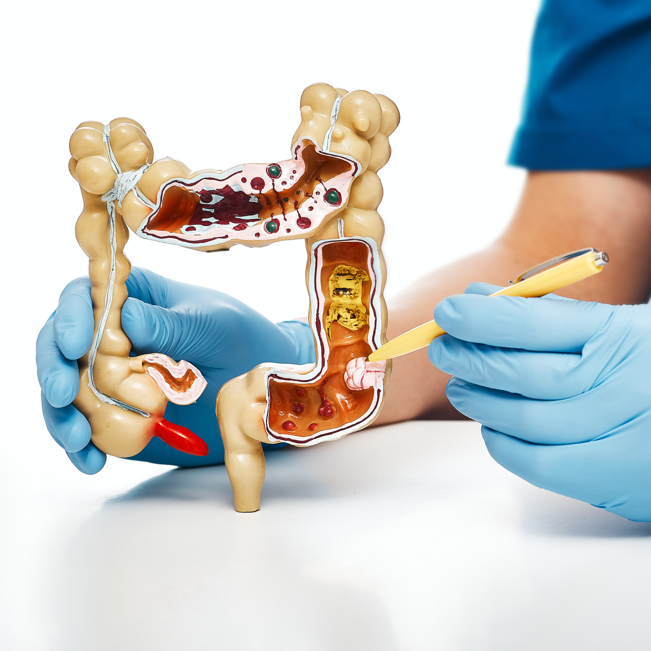 Kolon Kanserinden Korunmak İçin Hangi Gıdalar Tüketilmelidir?