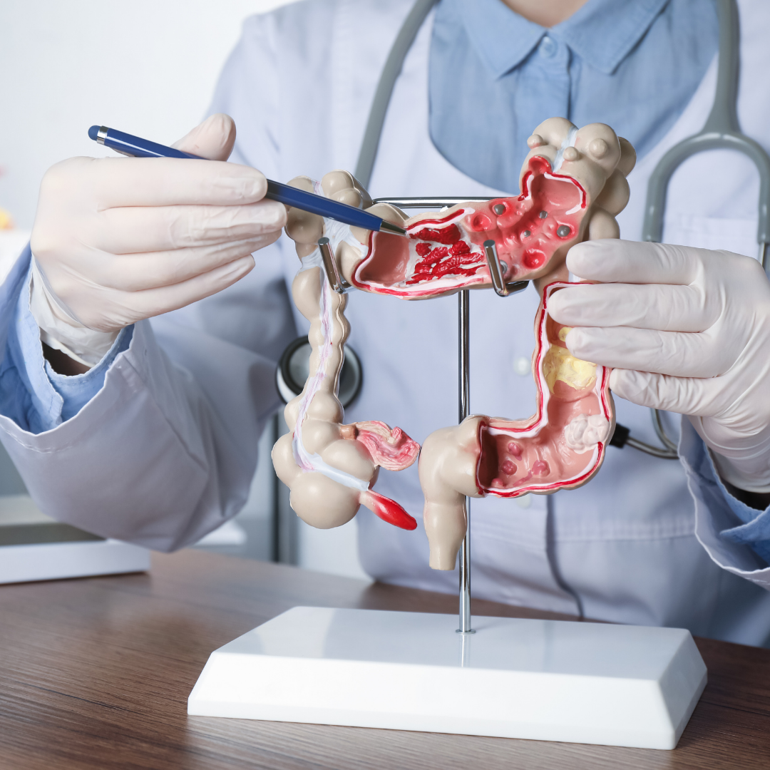 Bağırsak Kanseri Belirtileri Nelerdir?